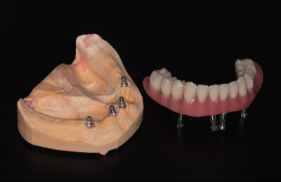 02_Gulickovy systém mini implantáty