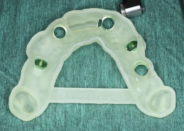 Navigovaná chirurgia, 5 implantátov