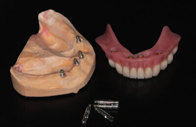 Gulickovy system, mini implantaty